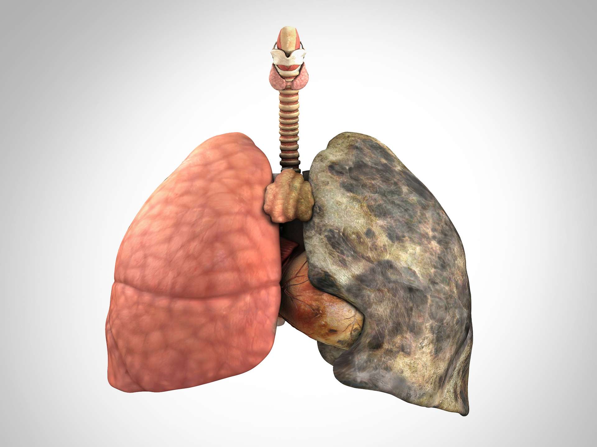 What is pulmonary hypertension ?